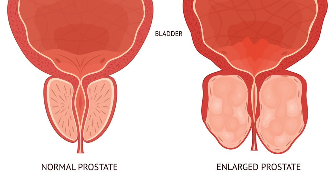 Bph Illustration