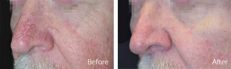 Cosmetic Laser Facial Spider Veins