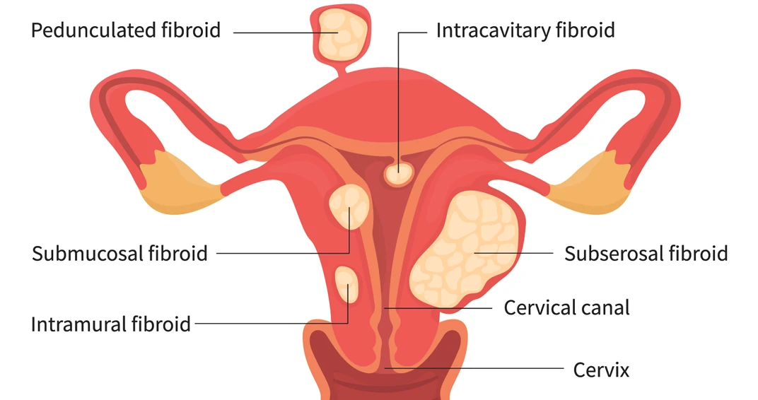 Fibroids