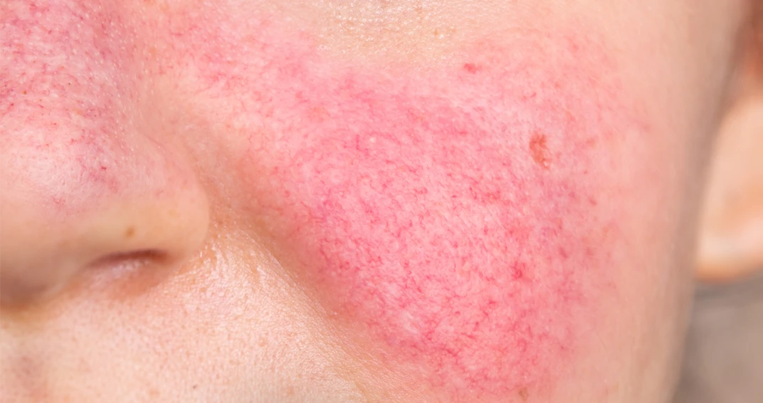 Rosacea