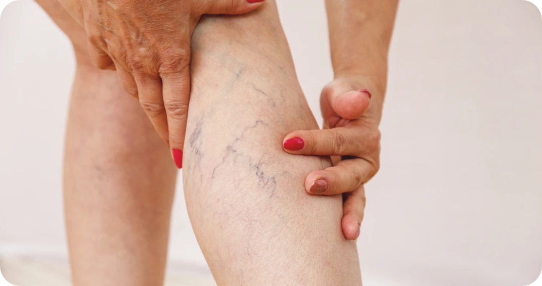 Spider Veins Calf