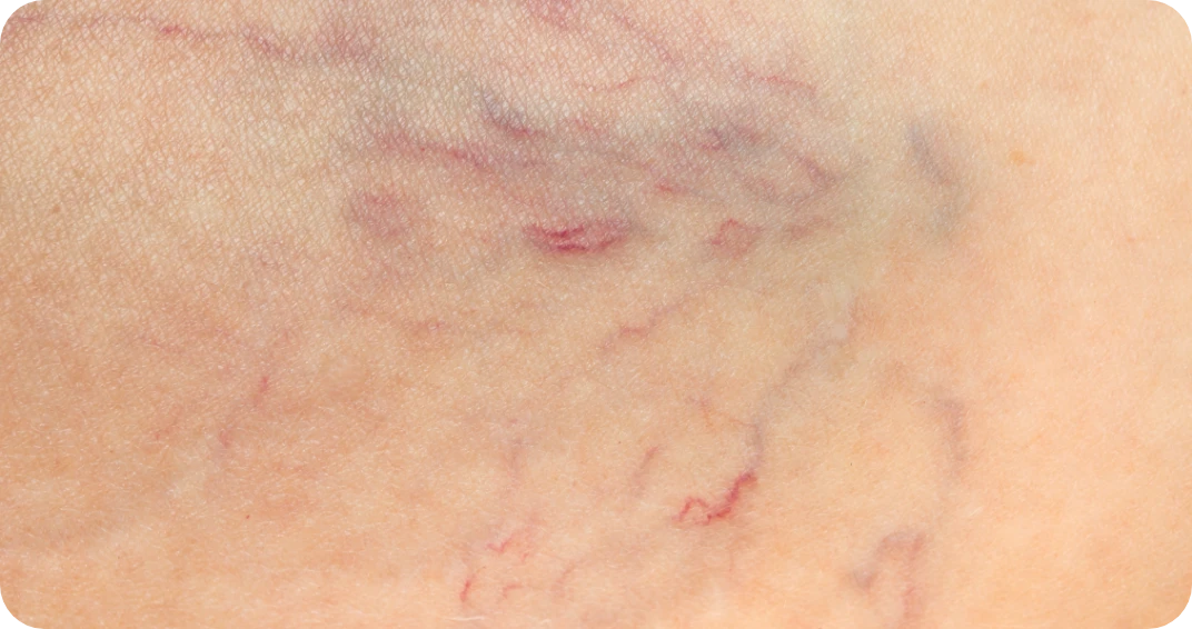 Spider Veins Close Up