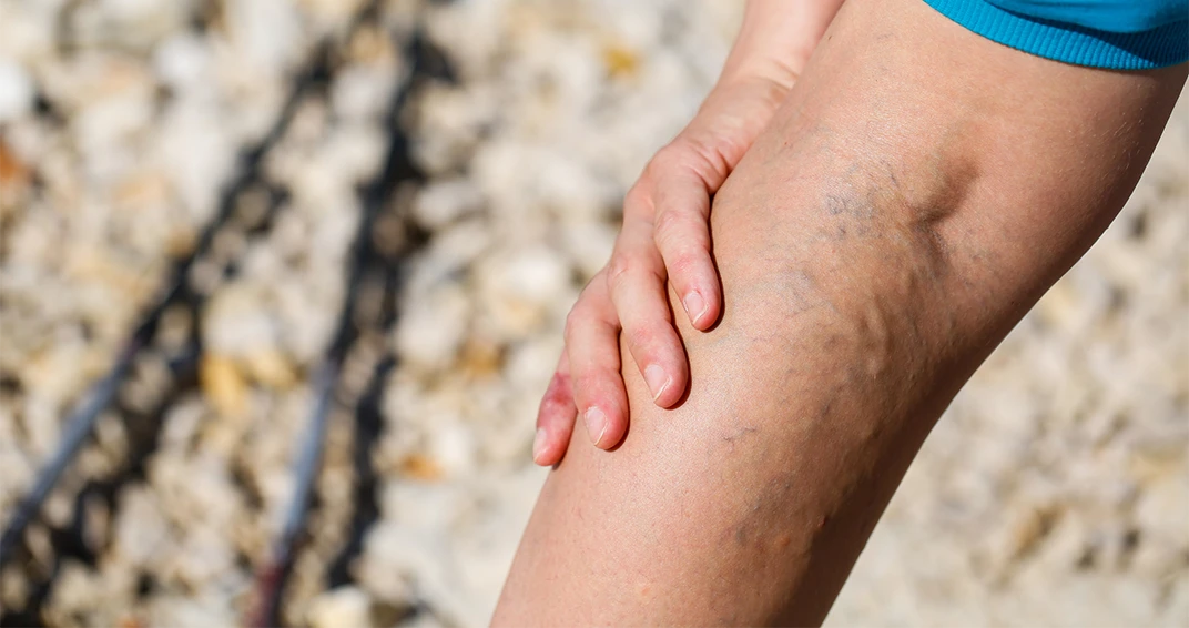 Varicose Veins 2