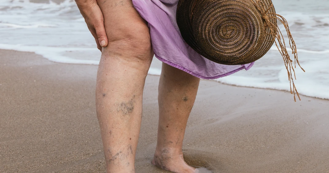 Varicose Veins 3