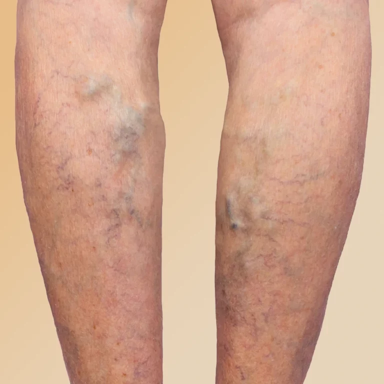 Varicose Veins