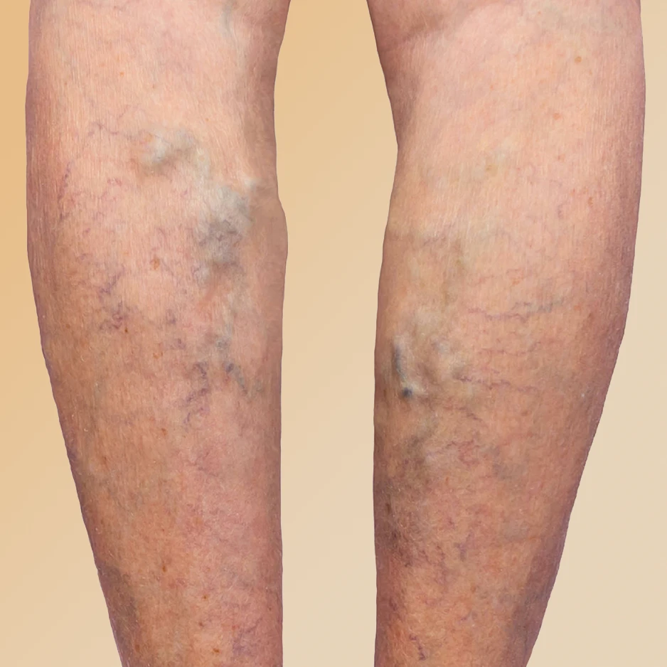 Varicose Veins