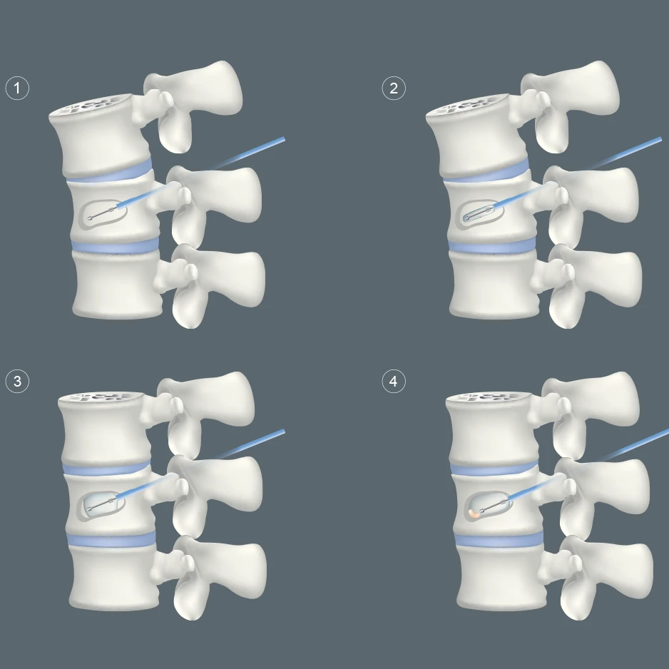 Kyphoplasty