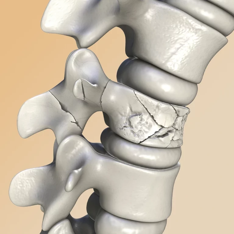 Spine Fracture