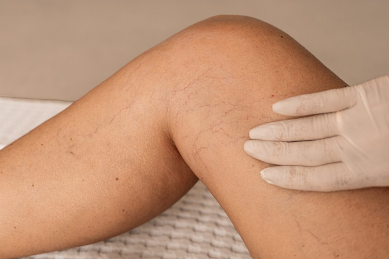 Close-up of a knee with visible varicose veins and capillaries. A gloved hand touches the skin, highlighting vascular issues.